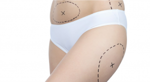 o que é vibrolipoaspiração dentro da cirurgia plástica