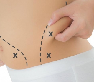 Para pneuzinhos na barriga e nas costas, a lipoaspiração é a melhor solução?